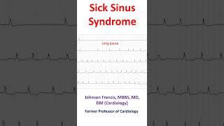 Sick Sinus Syndrome [upl. by Palocz]