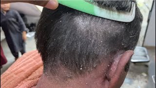 How to get rid dandruff flakes scratching with comb 🪮🥵scratching dandruff off scalp 1 [upl. by Sjoberg]