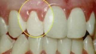 Periodontal Disease amp Treatment [upl. by Aralomo]