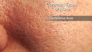 How to Treat Different Types of Acne [upl. by Assilem]