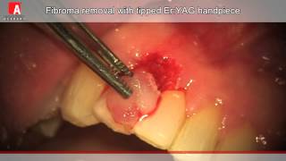 FIBROMA REMOVAL AND HEMOSTASIS Fotona Lightwalker ErYAG Laser [upl. by Spindell]