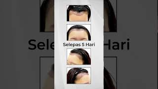 AESTHETIC CLINIC MALAYSIA  Hairline Transplant Day 5 PostSMART™ FUE Lowering Hairline [upl. by Richmound]