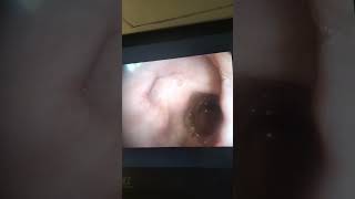 Endoscopy Duodenal quot Bulbarquot Ulcer [upl. by Binny]