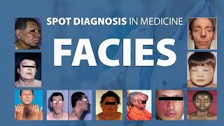 Abnormal Facies  Spot Diagnoses in Medicine [upl. by Oicnedif85]