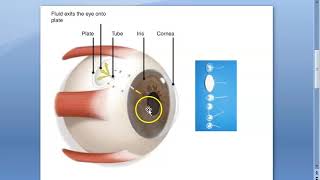 Ophthalmology Glaucoma Drainage Devices Seton Ex Press implant Molteno [upl. by Onaireves]