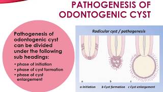 Pathogenesis of Odontogenic Cyst [upl. by Cirdes854]