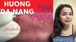 060 pustules around the lips and face  Hương Đà Nẵng [upl. by Llenrod171]