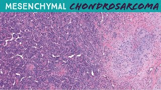 Mesenchymal Chondrosarcoma  round blue cell sarcoma with cartilage amp staghorn vessels UNC case 6 [upl. by Odinevneib]