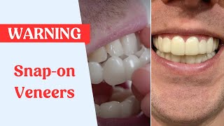 Snap On Veneers Warning [upl. by Andras213]