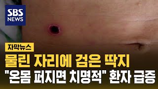 물린 자리에 검은 딱지…quot온몸 퍼지면 치명적quot 환자 급증 자막뉴스  SBS [upl. by Colas]