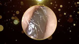 Hard Dark Stubborn Ear Wax Removal [upl. by Ynnob]