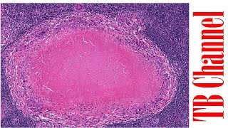 El granuloma de la tuberculosis [upl. by Akedijn]