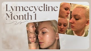 ACNE MONTH 1 ON LYMECYCLINE [upl. by Nnaik]