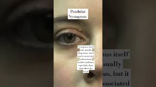 Involuntary movement of Eye Pendular Nystagmus shorts ytshortindia viral optometry doctor [upl. by Krischer]