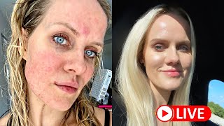 How I cured my ROSACEA naturally [upl. by Mollee]