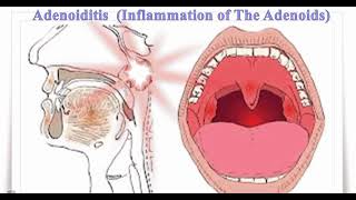 ADENOIDITIS Definition of adenoiditis Causes of adenoiditis Symptoms of adenoiditis✨ [upl. by Standish375]