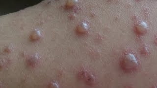 Chickenpox disease [upl. by Mackoff]