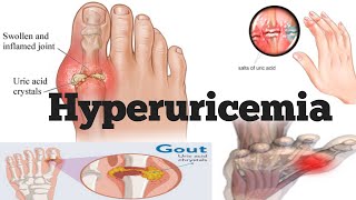 Hyperuricemia  Hyperuricemia Cause  Hyperuricemia Symptoms  Hyperuricemia Diagnosis amp treatment [upl. by Stanleigh]