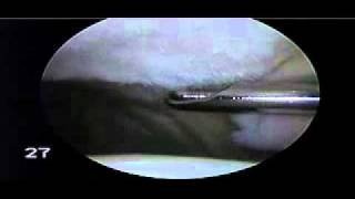 Chondroplasty Patella for Chondromalacia Patella  Dr Steven Struhl [upl. by Yruy155]