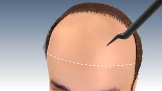 Step by Step FUE Hair Transplant Surgery in jaipur  Hair transplant in india  Outbloom clinics [upl. by Jareb]