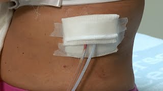 How to care for a postsurgery wound drainage system and gauze dressing [upl. by Iphlgenia]