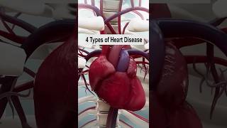 4 Types of Heart Disease hearthealth heartattack heart [upl. by Nagiem392]