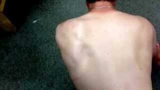 Baseball Player Winged Scapula First Rib Syndrome Ant Shoulder Pain Eval [upl. by Adnilra624]