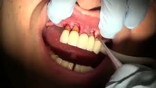 Dentist removes a dental bridge [upl. by Donna]