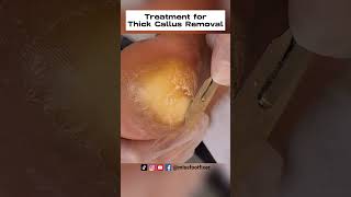 Palmoplantar Keratoderma Relief Expert Treatment for Thick Callus Removal by miss foot fixer [upl. by Ahsiket]