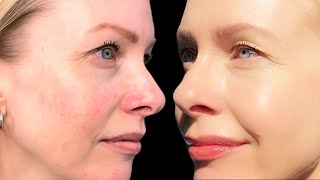 AZELAIC ACID  how to layer in your routine  it FIXED my ROSACEA [upl. by Acinorav]