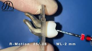 RMotion Reciprocating Sequence for Management of S Shaped Root Canal Educational Demo Video [upl. by Leahcym]