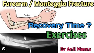 forearm fracture recovery time Monteggia fracture recovery time  forearm fracture  in hindi [upl. by Ardnos353]