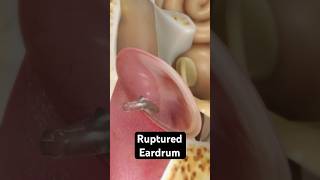 How does an eardrum rupture 3D Animation [upl. by Lindy]