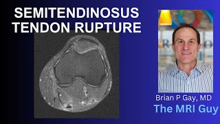 Semitendinosus tendon rupture [upl. by Robinett160]