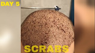 Hair Transplant Results DAY 5 FUE Turkey [upl. by Aicram]