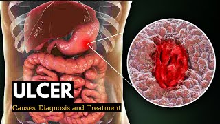 Ulcer Causes Signs and Symptoms Diagnosis and Treatment [upl. by Adnilasor]