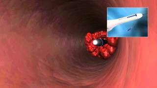 CLEANER15 Rotational Thrombectomy System [upl. by Manville]