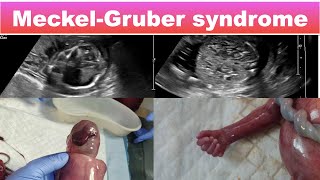 Meckel Gruber syndrome I Ultrasound [upl. by Retla345]