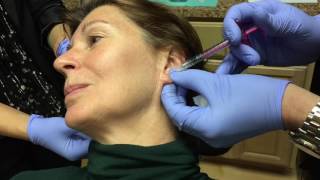 Juvederm Volbella Injection for Ear Lobe Rejuvenation [upl. by Boleyn]