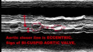 BICUSPID AORTIC VALVE  ECHOCARDIOGRAPHY SERIES BY DR ANKUR K CHAUDHARI [upl. by Cleodel]