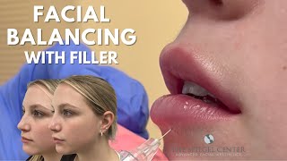 Balancing the Face with Filler  Live Injection by RealSelfs Most Loved Injector [upl. by Nauh874]