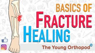 Fracture Healing  ANIMATION  BASICS  The Young Orthopod [upl. by Crocker]