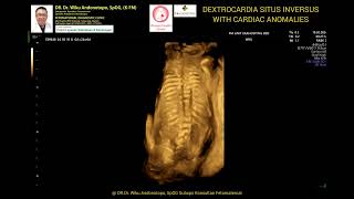 Dextrocardia Situs Inversus 24 weeks [upl. by Ardnusal]