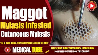 Maggot Myiasis Infested Skin  Causes Symptoms and Treatment  Medical Tube [upl. by Taffy]