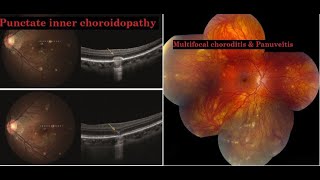 Punctate inner choroidopathy PIC amp Multifocal choroiditis and panuveitis MFC KanskiSeries 2022 [upl. by Oaoj]