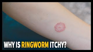 All you need to know about Ringworm Why is it itchy [upl. by Tompkins]