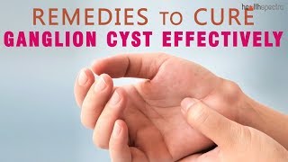 10 Remedies to Cure Ganglion Cyst Effectively [upl. by Airel]