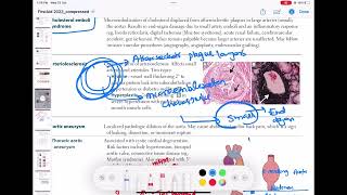 Cholesterol emboli syndrome cardiology 69  First Aid USMLE Step 1 in UrduHindi [upl. by Pero]