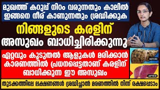 മുഖത്ത് കറുപ്പ് നിറം വരുന്നതും കാലിൽ ഇങ്ങനെ നീര് കാണുന്നതും ലിവർ അസുഖത്തിന്റെ തുടക്കമാണ്  liver [upl. by Slaohcin350]