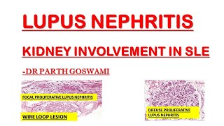 Lupus Nephritis  Wire Loop Lesion [upl. by Adnilym901]